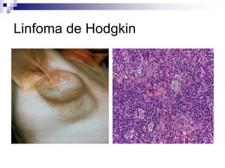 Linfoma de Hodgkin
 