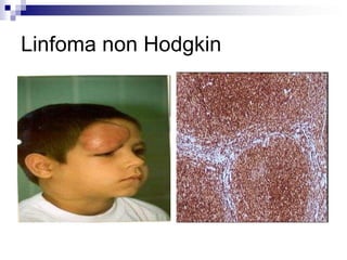 Linfoma non Hodgkin
 