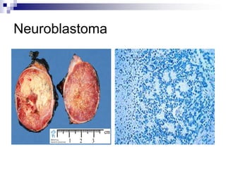 Neuroblastoma
 