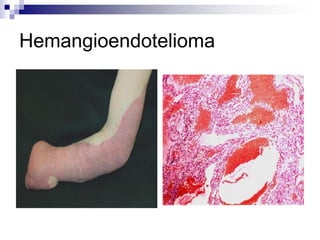 Hemangioendotelioma
 