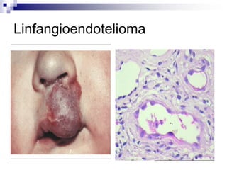 Linfangioendotelioma
 