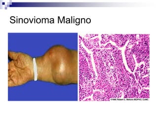 Sinovioma Maligno
 