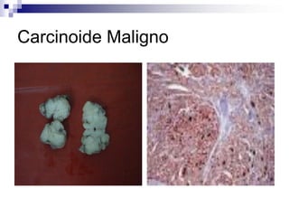 Carcinoide Maligno
 