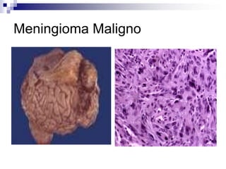 Meningioma Maligno
 
