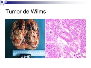 Tumor de Wilms
 