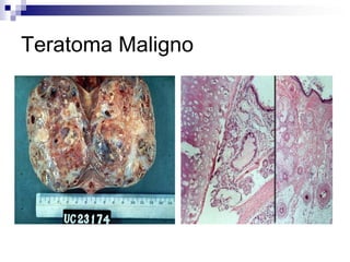 Teratoma Maligno
 