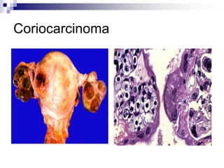 Coriocarcinoma
 