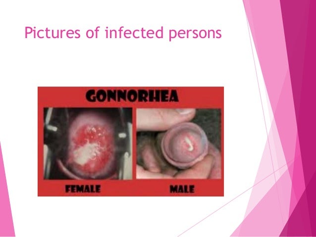 gonorrhea symptoms pictures men