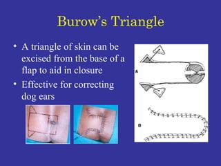 Burow’s Triangle A triangle of skin can be excised from the base of a flap to aid in closure Effective for correcting dog ears 
