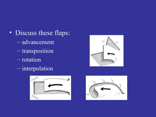 Discuss these flaps: advancement transposition  rotation interpolation 