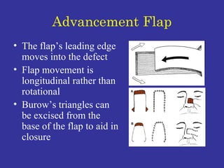 Advancement Flap The flap’s leading edge moves into the defect Flap movement is longitudinal rather than rotational Burow’s triangles can be excised from the base of the flap to aid in closure 