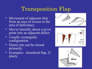 Transposition Flap Movement of adjacent skin from an area of excess to the area of deficiency Moves laterally about a pivot point into an adjacent defect Usually rectangular configuration Donor site can be closed primarily Examples:  rhomboid flap, Z-plasty 