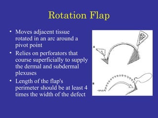 Rotation Flap Moves adjacent tissue rotated in an arc around a pivot point Relies on perforators that course superficially to supply the dermal and subdermal plexuses Length of the flap's perimeter should be at least 4 times the width of the defect 