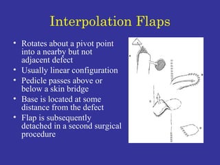 Interpolation Flaps Rotates about a pivot point into a nearby but not adjacent defect Usually linear configuration Pedicle passes above or below a skin bridge Base is located at some distance from the defect Flap is subsequently detached in a second surgical procedure 