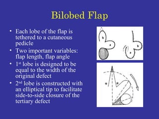 Bilobed Flap Each lobe of the flap is tethered to a cutaneous pedicle Two important variables: flap length, flap angle 1 st  lobe is designed to be equal to the width of the original defect 2 nd  lobe is constructed with an elliptical tip to facilitate side-to-side closure of the tertiary defect 