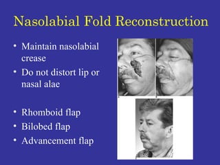 Nasolabial Fold Reconstruction Maintain nasolabial crease Do not distort lip or nasal alae Rhomboid flap Bilobed flap Advancement flap 