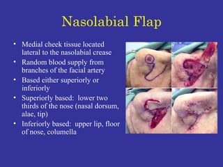 Nasolabial Flap Medial cheek tissue located lateral to the nasolabial crease  Random blood supply from branches of the facial artery  Based either superiorly or inferiorly Superiorly based:  lower two thirds of the nose (nasal dorsum, alae, tip)  Inferiorly based:  upper lip, floor of nose, columella  