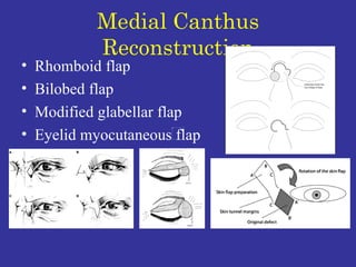 Medial Canthus Reconstruction Rhomboid flap Bilobed flap Modified glabellar flap Eyelid myocutaneous flap 