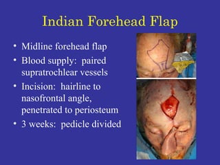 Indian Forehead Flap Midline forehead flap Blood supply:  paired supratrochlear vessels Incision:  hairline to nasofrontal angle, penetrated to periosteum 3 weeks:  pedicle divided  