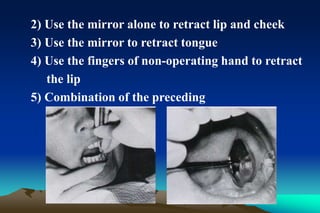 2) Use the mirror alone to retract lip and cheek
3) Use the mirror to retract tongue
4) Use the fingers of non-operating hand to retract
the lip
5) Combination of the preceding
 