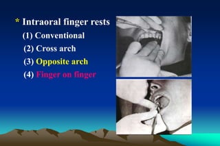 * Intraoral finger rests
(1) Conventional
(2) Cross arch
(3) Opposite arch
(4) Finger on finger
 