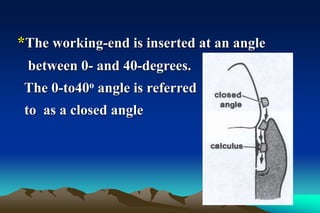 *The working-end is inserted at an angle
between 0- and 40-degrees.
The 0-to40o angle is referred
to as a closed angle
 
