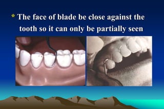 * The face of blade be close against the
tooth so it can only be partially seen
 