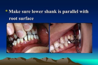 * Make sure lower shank is parallel with
root surface
 