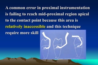 A common error in proximal instrumentation
is failing to reach mid-proximal region apical
to the contact point because this area is
relatively inaccessible and this technique
require more skill
 