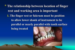 * The relationship between location of finger
rest and working area is important
1. The finger rest or fulcrum must be position
to allow lower shank of instrument to be
parallel or nearly parallel with tooth surface
being treated
 