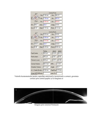 Valorile keratometrului pentru suprafaţa anterioară şi posterioară a corneei; grosimea
corneei prin centrul pupilei şi la marginea ei
Imagine prin sistemul Pentacam
 