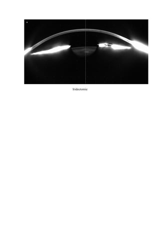 Iridectomie
 
