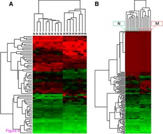 Differences in microRNA expression during tumor development in the transition and peripheral zones of the prostate