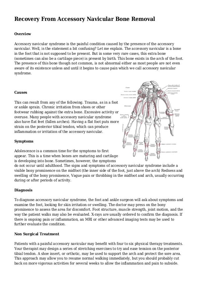Recovery From Accessory Navicular Bone Removal