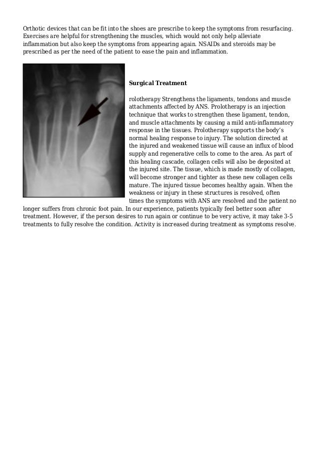 Extra Bone In Foot Accessory Navicular