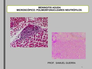 MENINGITIS AGUDA
MICROSCÓPICO: POLIMORFONUCLEARES NEUTRÓFILOS.
PROF. SAMUEL GUERRA
10
 