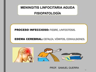 MENINGITIS LINFOCITARIA AGUDA
FISIOPATOLOGÍA
PROCESO INFECCIOSO: FIEBRE, LINFOCITOSIS.
EDEMA CEREBRAL: CEFALEA, VÓMITOS, CONVULSIONES.
PROF. SAMUEL GUERRA
14
 