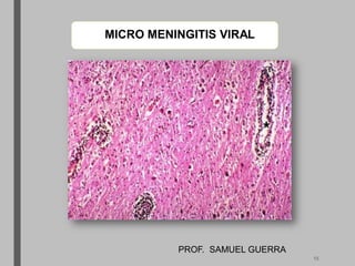 MICRO MENINGITIS VIRAL
PROF. SAMUEL GUERRA
15
 