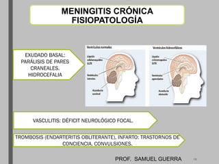 MENINGITIS CRÓNICA
FISIOPATOLOGÍA
EXUDADO BASAL:
PARÁLISIS DE PARES
CRANEALES.
HIDROCEFALIA
VASCULITIS: DÉFICIT NEUROLÓGICO FOCAL.
TROMBOSIS (ENDARTERITIS OBLITERANTE), INFARTO: TRASTORNOS DE
CONCIENCIA. CONVULSIONES.
PROF. SAMUEL GUERRA 18
 