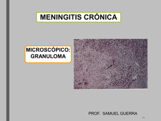 MENINGITIS CRÓNICA
MICROSCÓPICO:
GRANULOMA
PROF. SAMUEL GUERRA
19
 