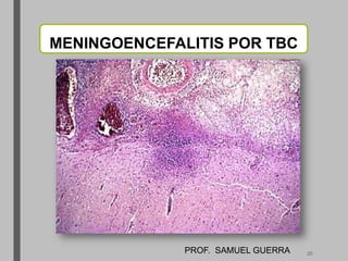MENINGOENCEFALITIS POR TBC
PROF. SAMUEL GUERRA 20
 