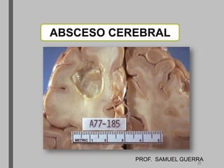 ABSCESO CEREBRAL
PROF. SAMUEL GUERRA
22
 