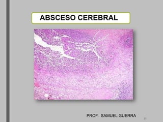 ABSCESO CEREBRAL
PROF. SAMUEL GUERRA
23
 