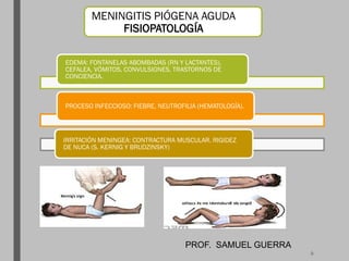 MENINGITIS PIÓGENA AGUDA
FISIOPATOLOGÍA
EDEMA: FONTANELAS ABOMBADAS (RN Y LACTANTES),
CEFALEA, VÓMITOS, CONVULSIONES, TRASTORNOS DE
CONCIENCIA.
PROCESO INFECCIOSO: FIEBRE, NEUTROFILIA (HEMATOLOGÍA).
IRRITACIÓN MENINGEA: CONTRACTURA MUSCULAR. RIGIDEZ
DE NUCA (S. KERNIG Y BRUDZINSKY)
PROF. SAMUEL GUERRA
9
 