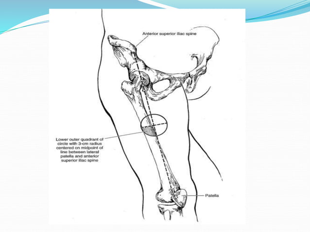 anterolateral thigh flap | PPT