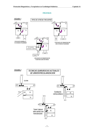 Protocolos Diagnósticos y Terapéuticos en Cardiología Pediátrica                                                  Capítulo 14



                                                           FIGURAS


FIGURA 1                                  TIPOS DE ATRESIA TRICUSPIDE

    AD                    AI                                                     AD                  AI




     VD               VI                                                              VD        VI




     AP
                     Ao                              AD             AI                Ao      AP
CON VASOS NORMALES
Y ESTENOSIS PULMONAR                                                             CON VASOS EN TRANSPOSICON
                                                                                  SIN ESTENOSIS PULMONAR
                                                      VD         VI
                                CIV restrictiva
                               (estenosis “subAo”)

                                                     Ao
                                                               AP
                                             CoAo

                                              CON VASOS EN TRANSPOSICON
                                               Y OBSTRUCCION SISTEMICA




 FIGURA 2                        TECNICAS QUIRURGICAS ACTUALES
                                   DE UNIVENTRICULARIZACION
               VCS
                                                                                             VCS

                     GLENN


   APD                                      API                                        APD                        API


         VCI         AD             AI                                           Conducto                 AI
                                                                                extracardíaco
                                                           VCS                                               VI
                                     VI
                                                                                                VCI

                                                     APD                        API

                                             Túnel lateral
                                                                          AI
                                            intra-atrial con
                                             fenestración
                                                                           VI
                                                               VCI




                                                                -7-
 