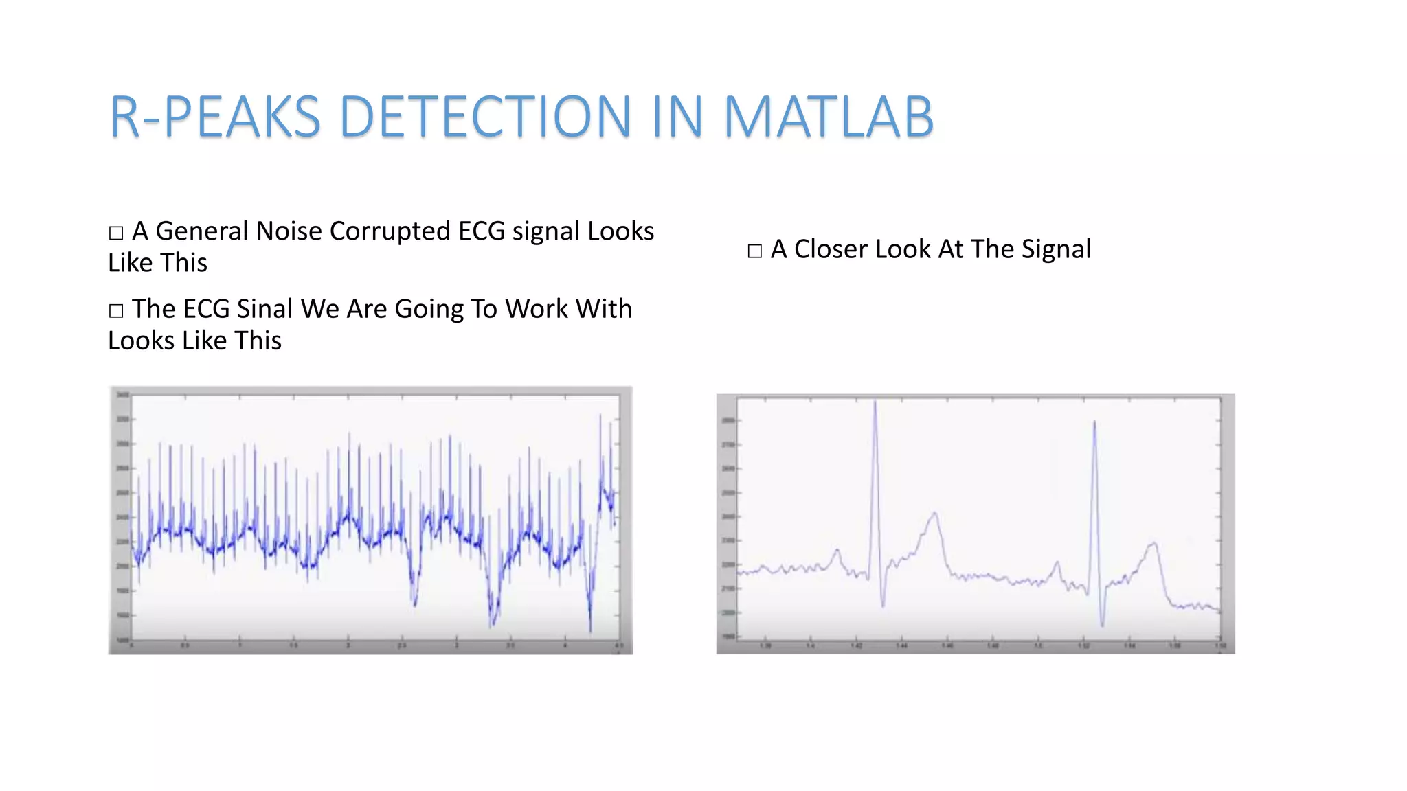 R-PEAKS DETECTION IN MATLAB
□ A General Noise Corrupted ECG signal Looks
Like This
□ The ECG Sinal We Are Going To Work With
Looks Like This
□ A Closer Look At The Signal
 