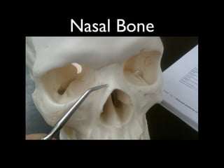 Nasal Bone
 