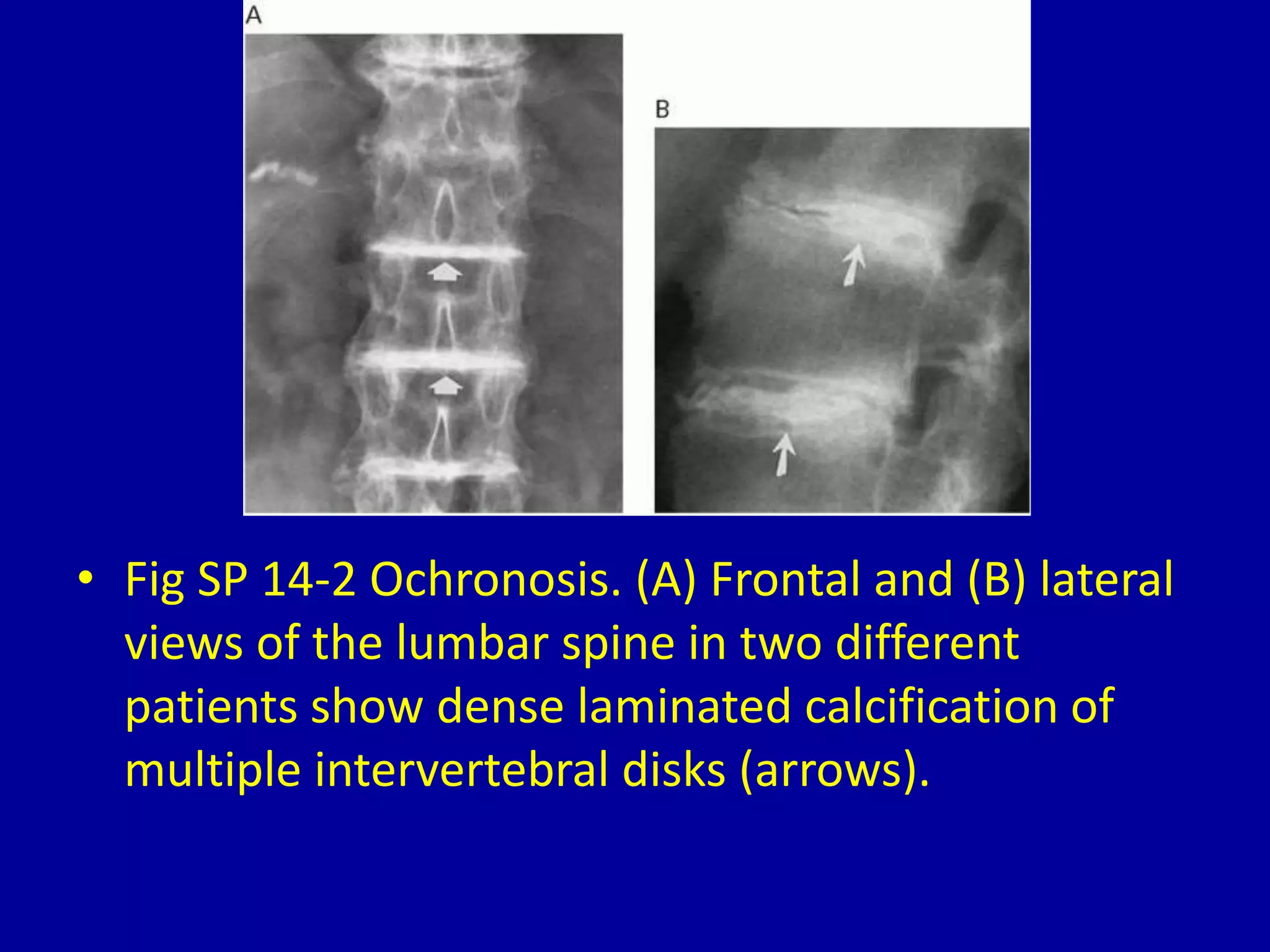 14 calcification of intervertebral disks | PPTX