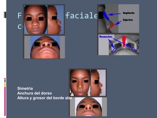 Fracturas faciales
centrales
Simetria
Anchura del dorso
Altura y grosor del borde alar
 